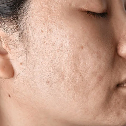 Pigmentation Treatment
